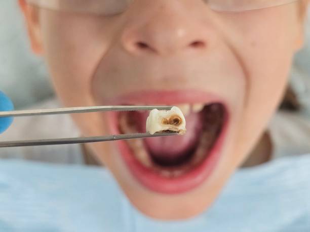 Best Emergency Tooth Extraction in Rustburg, VA